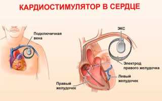 Показания к имплантации кардиовертера дефибриллятора
