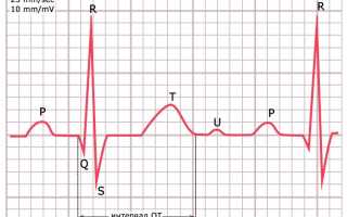 Что такое интервал qt в кардиологии