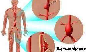 Признаки аневризмы аорты брюшной полости