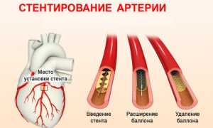 Стентирование сосудов сердца как проводится операция