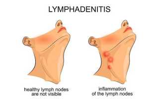 Лимфаденопатия периферических лимфоузлов