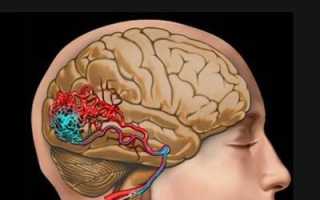 Венозная дисциркуляция головного мозга лечение