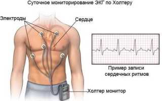 Холтеровское мониторирование сердечного ритма и артериального давления